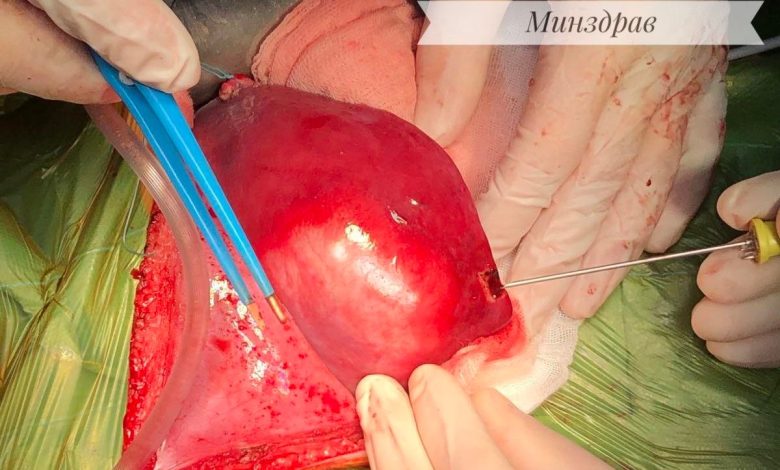 Белорусские хирурги впервые выполнили сложнейшую операцию