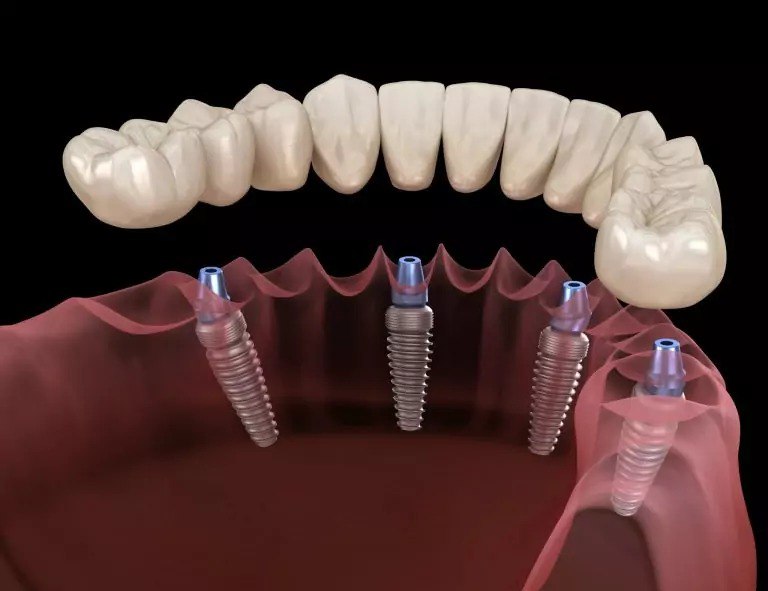 Какую имплантацию зубов выбрать
