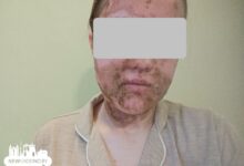 химический ожог лица