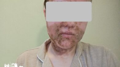 химический ожог лица