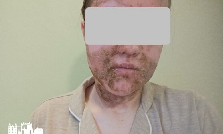 химический ожог лица