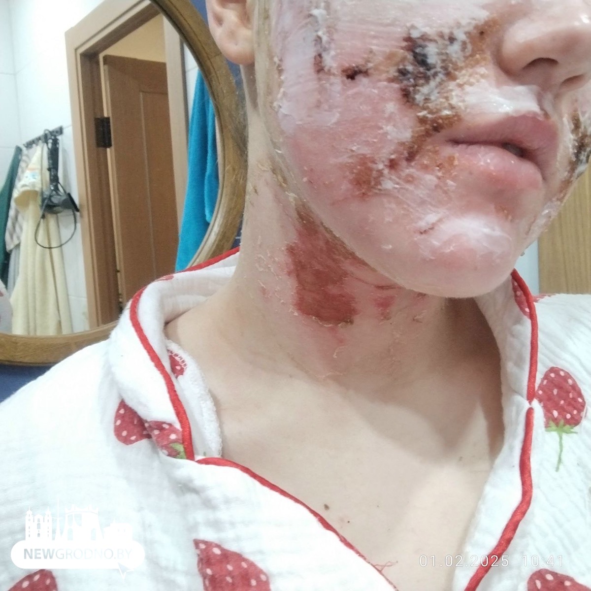 химический ожог лица