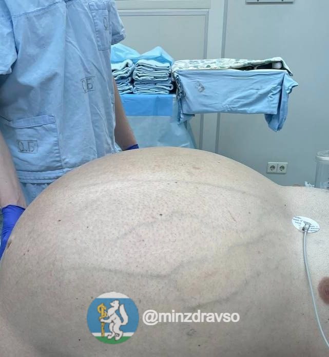 российские хирурги спасли мужчину от 60-килограммовой опухоли