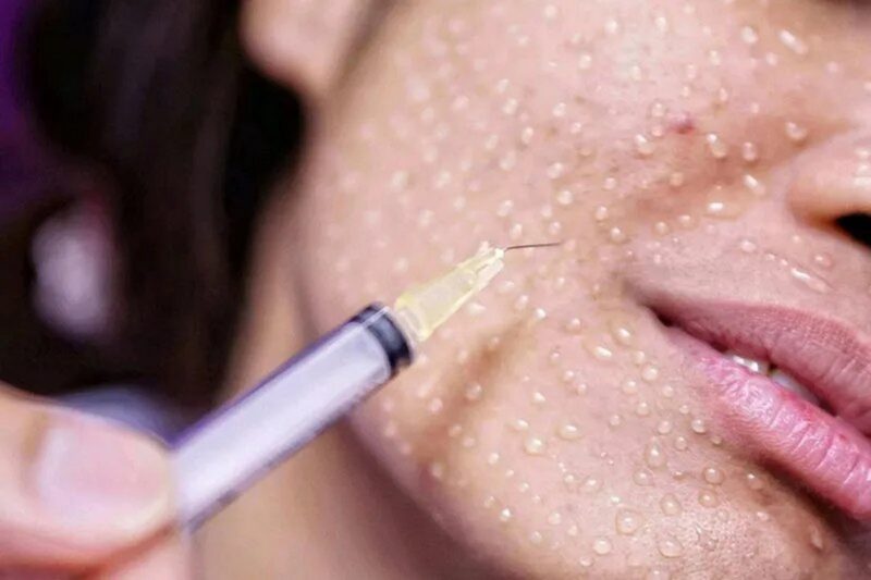 «Мастера» ботокса из соцсетей