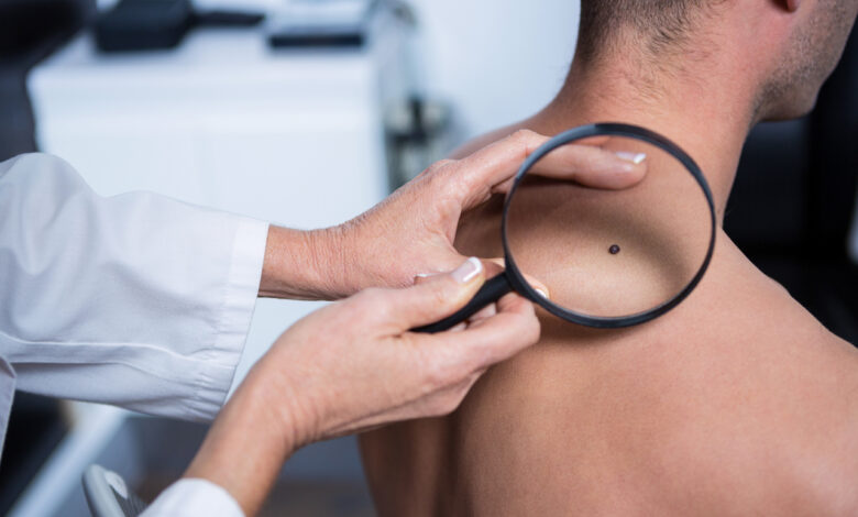 7 признаков меланомы