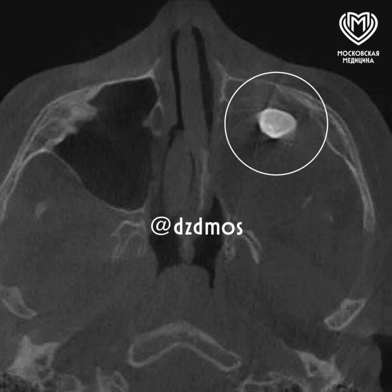 У подростка в носу вырос настоящий