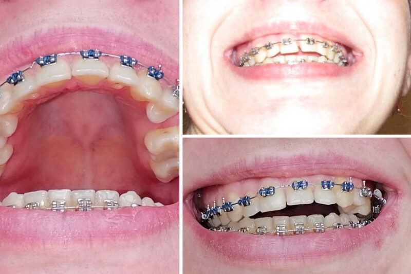 Семь лет в брекетах и без эффекта