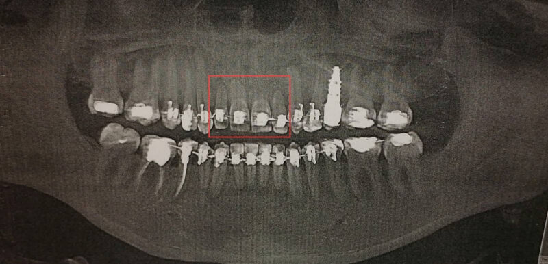 Семь лет в брекетах и без эффекта
