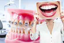 Семь лет в брекетах и без эффекта