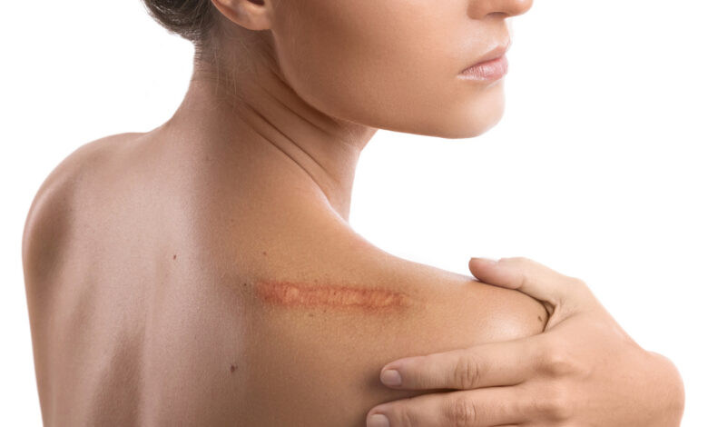 Мази от рубцов — бесполезны?